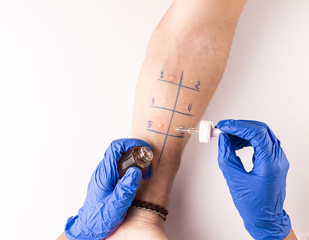 prick-test prick test
